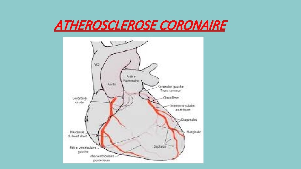 ATHEROSCLEROSE CORONAIRE 