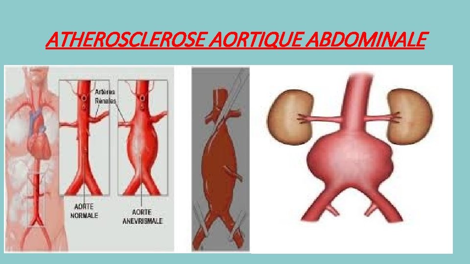 ATHEROSCLEROSE AORTIQUE ABDOMINALE 