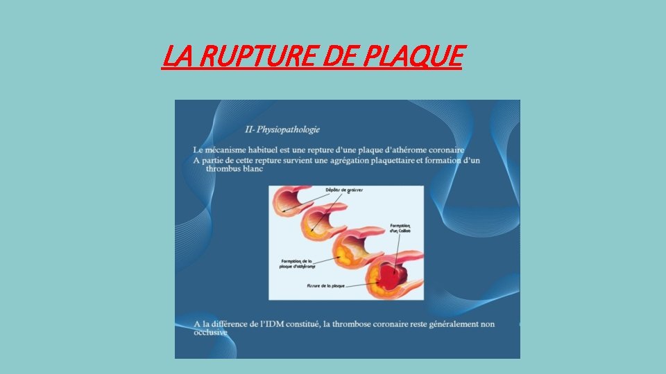 LA RUPTURE DE PLAQUE 