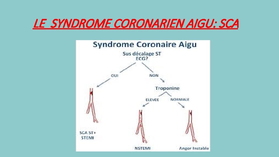 LE SYNDROME CORONARIEN AIGU: SCA 