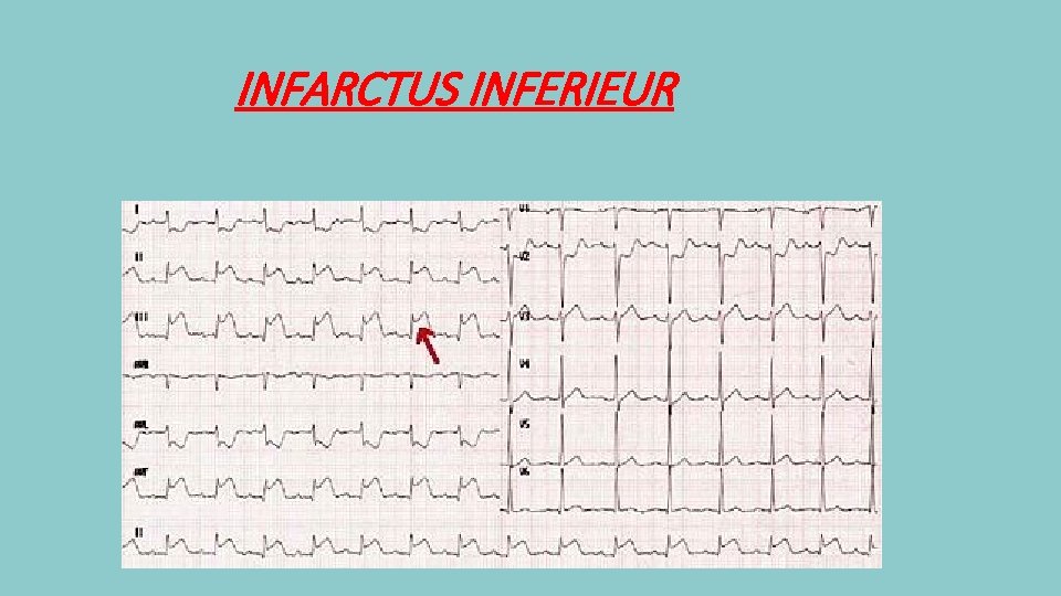 INFARCTUS INFERIEUR 