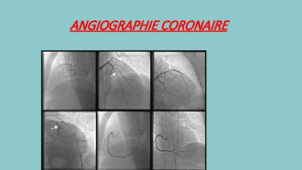 ANGIOGRAPHIE CORONAIRE 