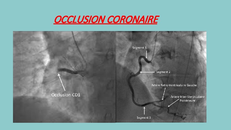 OCCLUSION CORONAIRE 