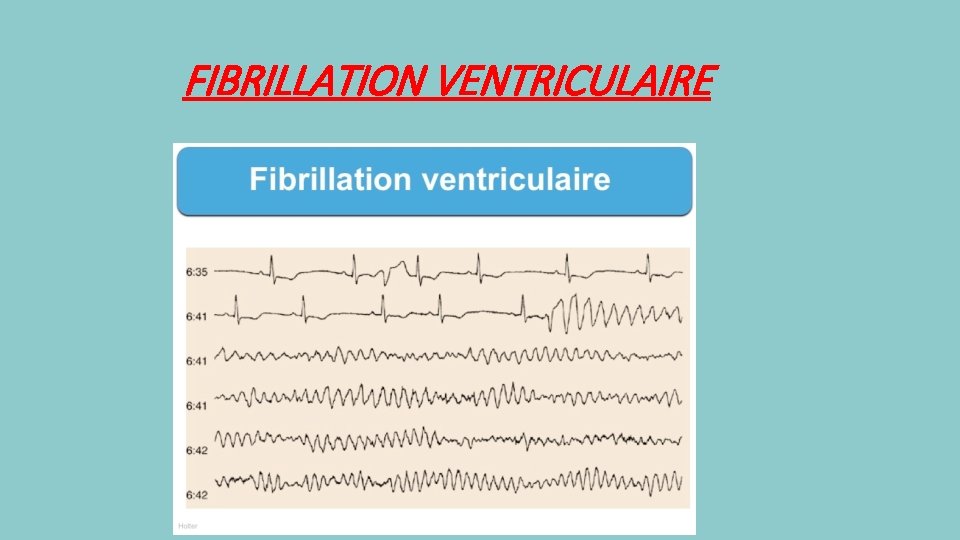 FIBRILLATION VENTRICULAIRE 