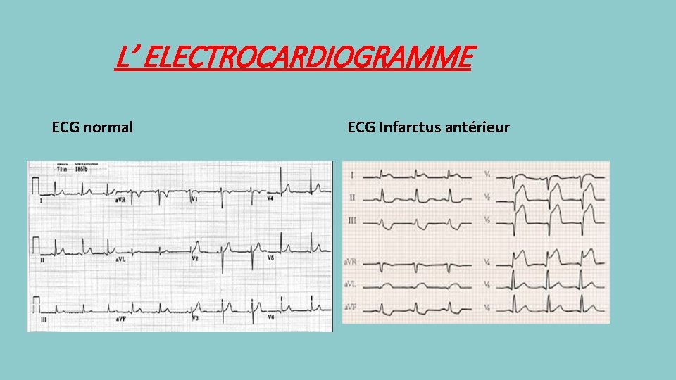 L’ ELECTROCARDIOGRAMME ECG normal ECG Infarctus antérieur 