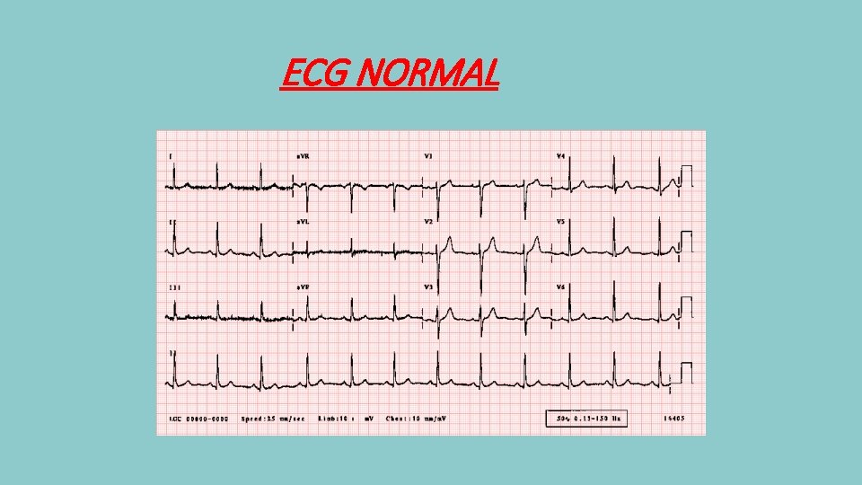 ECG NORMAL 