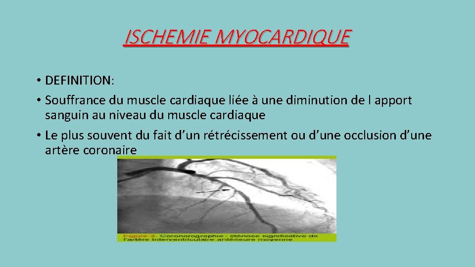 ISCHEMIE MYOCARDIQUE • DEFINITION: • Souffrance du muscle cardiaque liée à une diminution de