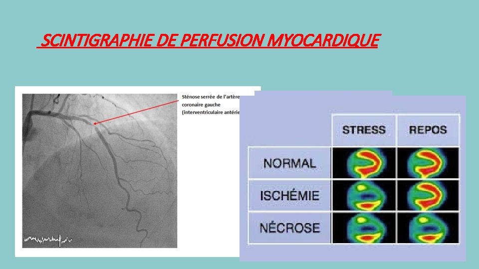 SCINTIGRAPHIE DE PERFUSION MYOCARDIQUE 