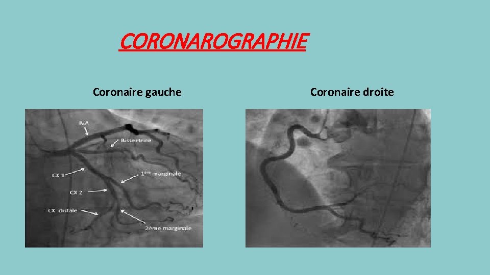 CORONAROGRAPHIE Coronaire gauche Coronaire droite 