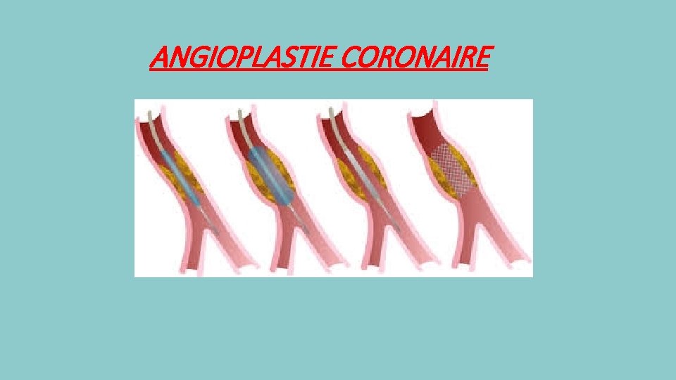 ANGIOPLASTIE CORONAIRE 