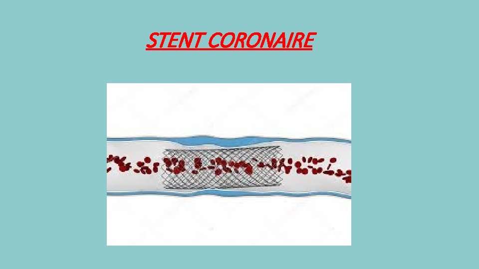 STENT CORONAIRE 