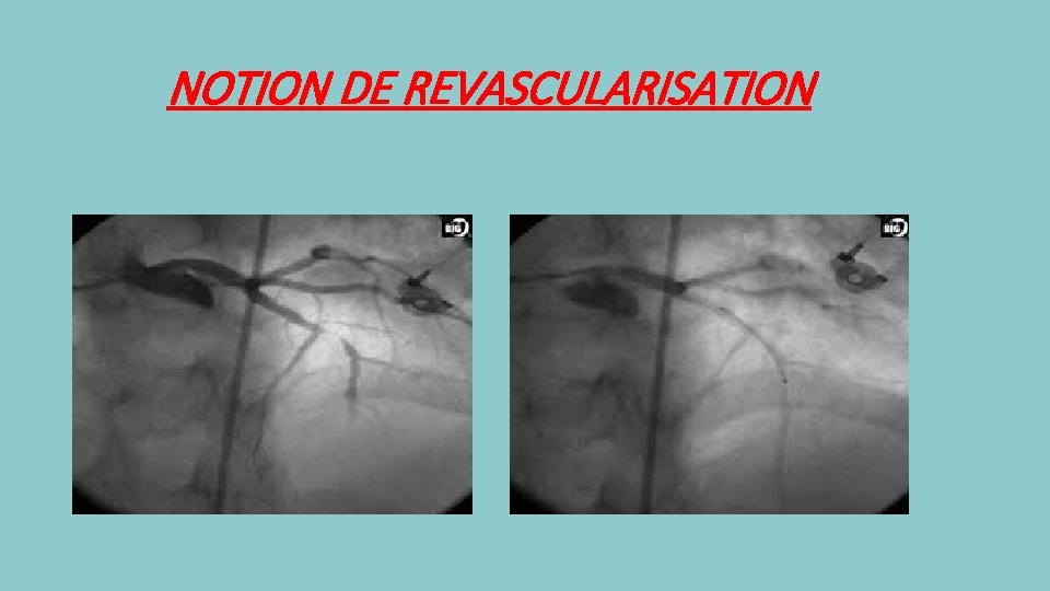 NOTION DE REVASCULARISATION 