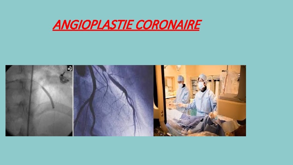 ANGIOPLASTIE CORONAIRE 