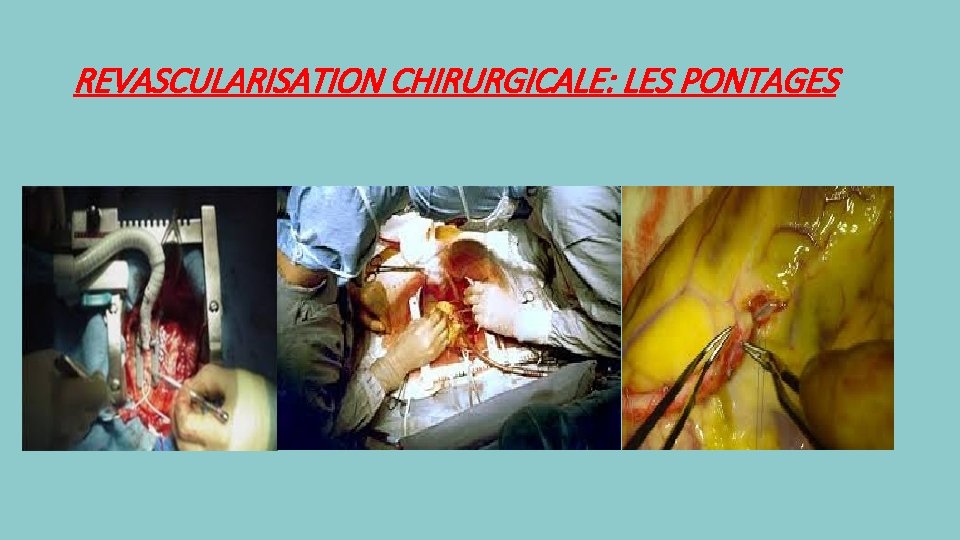 REVASCULARISATION CHIRURGICALE: LES PONTAGES 