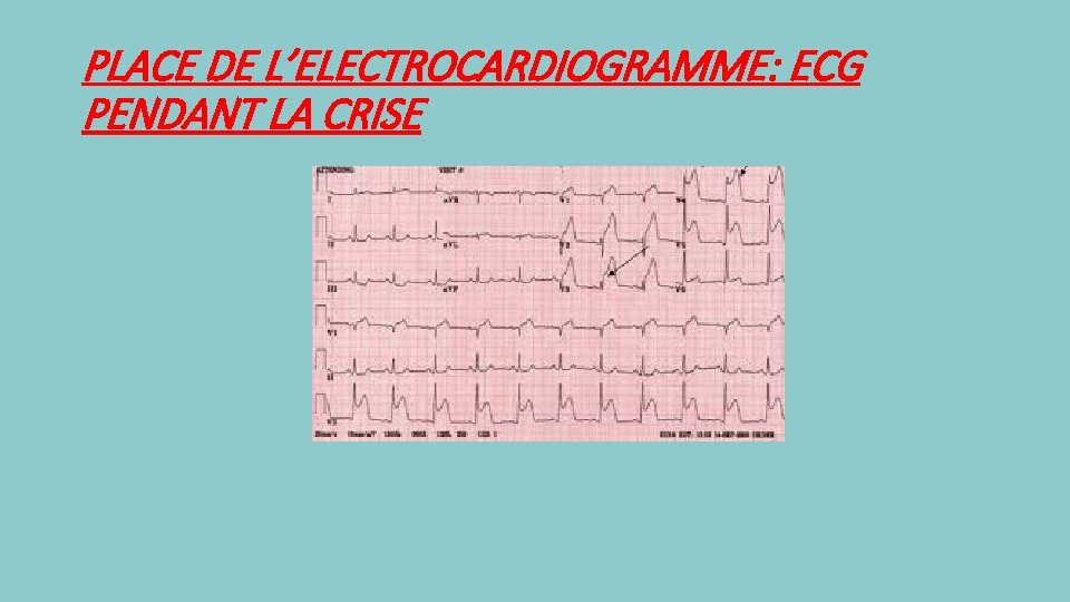 PLACE DE L’ELECTROCARDIOGRAMME: ECG PENDANT LA CRISE 