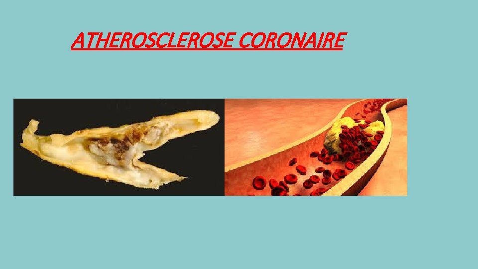 ATHEROSCLEROSE CORONAIRE 