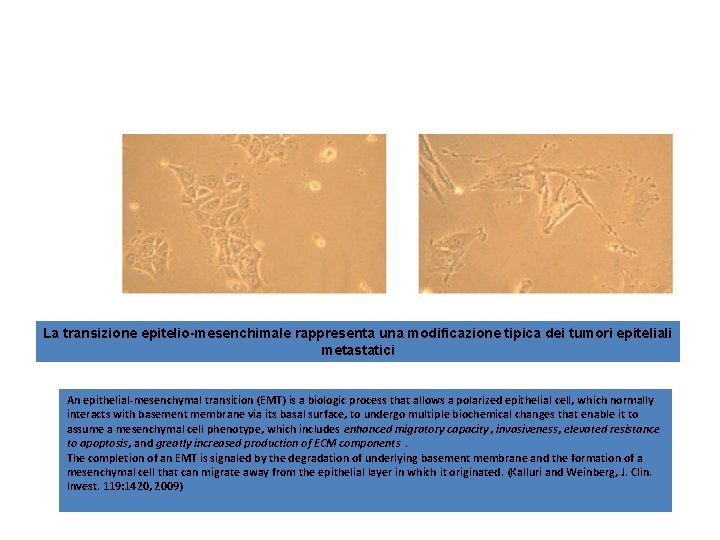 La transizione epitelio-mesenchimale rappresenta una modificazione tipica dei tumori epiteliali metastatici An epithelial-mesenchymal transition La transizione epitelio-mesenchimale rappresenta una modificazione tipica dei tumori epiteliali metastatici An epithelial-mesenchymal transition