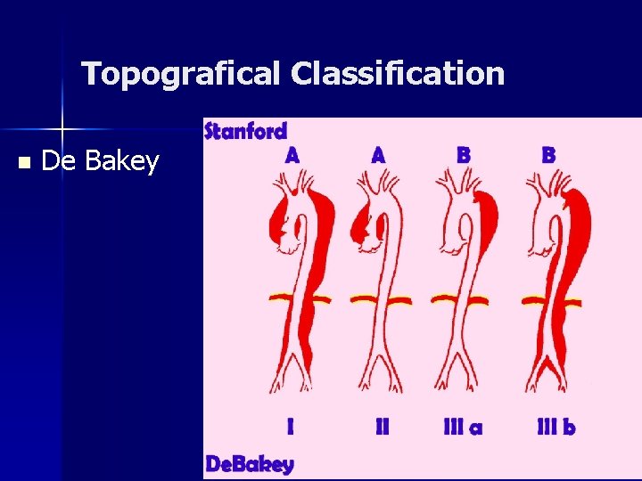 Topografical Classification n De Bakey Topografical Classification n De Bakey