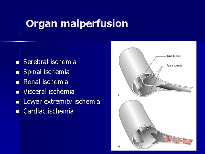 Organ malperfusion n n n Serebral ischemia Spinal ischemia Renal ischemia Visceral ischemia Lower Organ malperfusion n n n Serebral ischemia Spinal ischemia Renal ischemia Visceral ischemia Lower