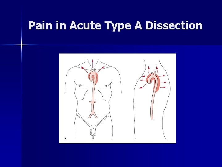 Pain in Acute Type A Dissection Pain in Acute Type A Dissection
