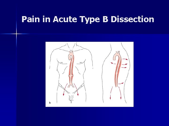 Pain in Acute Type B Dissection Pain in Acute Type B Dissection