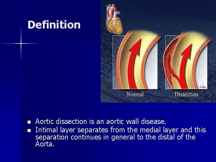 Definition n n Aortic dissection is an aortic wall disease. Intimal layer separates from Definition n n Aortic dissection is an aortic wall disease. Intimal layer separates from