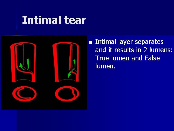 Intimal tear n Intimal layer separates and it results in 2 lumens: True lumen Intimal tear n Intimal layer separates and it results in 2 lumens: True lumen