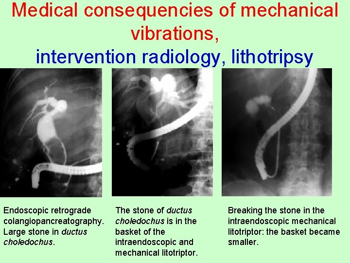 Medical consequencies of mechanical vibrations, intervention radiology, lithotripsy Endoscopic retrograde colangiopancreatography. Large stone in