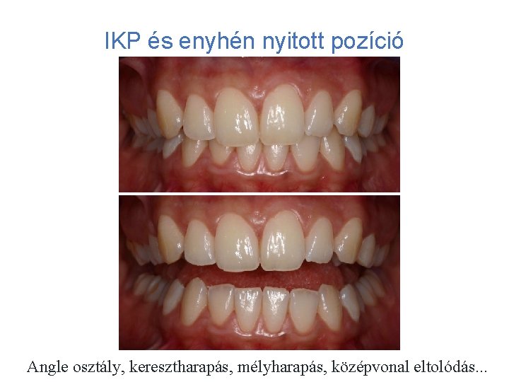 IKP és enyhén nyitott pozíció Angle osztály, keresztharapás, mélyharapás, középvonal eltolódás. . . 