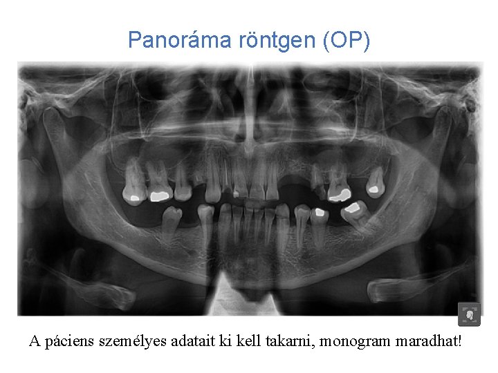 Panoráma röntgen (OP) A páciens személyes adatait ki kell takarni, monogram maradhat! 