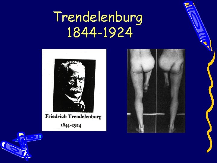 Trendelenburg 1844 -1924 Trendelenburg 1844 -1924