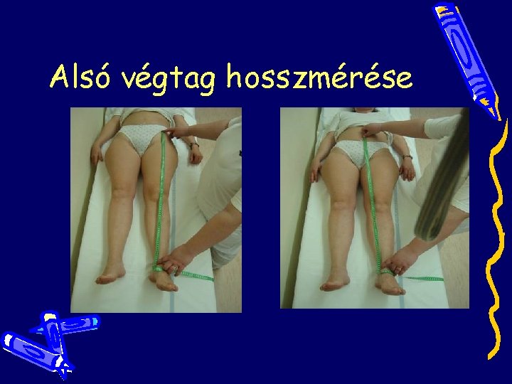 Alsó végtag hosszmérése Alsó végtag hosszmérése