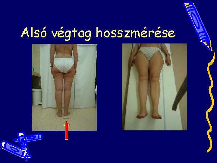 Alsó végtag hosszmérése Alsó végtag hosszmérése