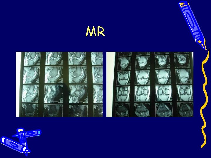 MR MR