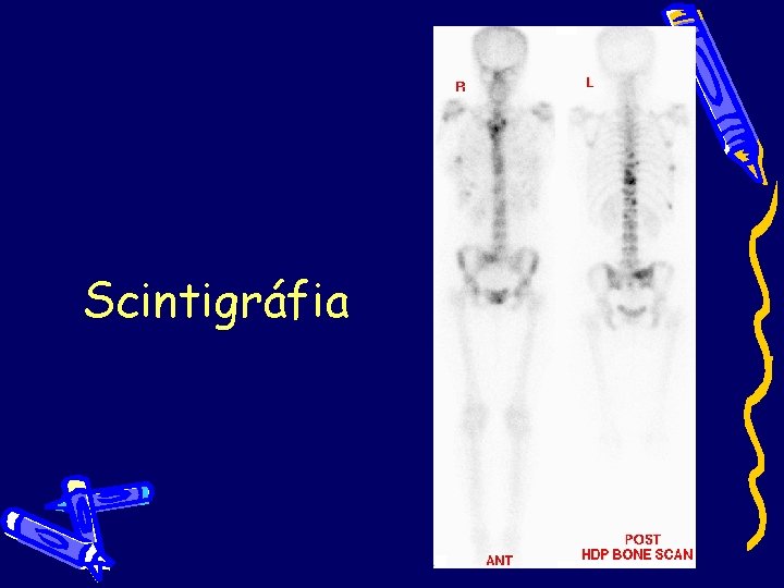 Scintigráfia Scintigráfia