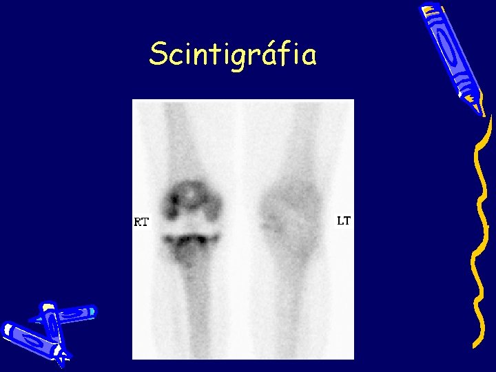 Scintigráfia Scintigráfia