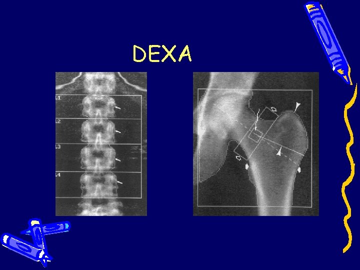 DEXA DEXA