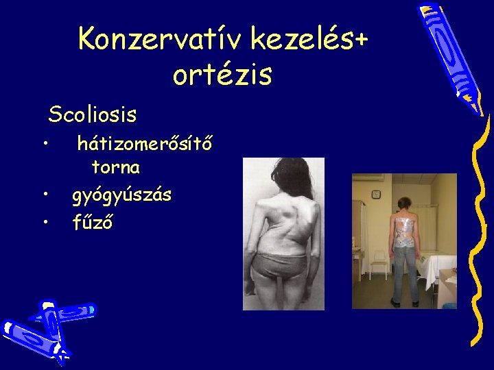 Konzervatív kezelés+ ortézis Scoliosis • • • hátizomerősítő torna gyógyúszás fűző Konzervatív kezelés+ ortézis Scoliosis • • • hátizomerősítő torna gyógyúszás fűző