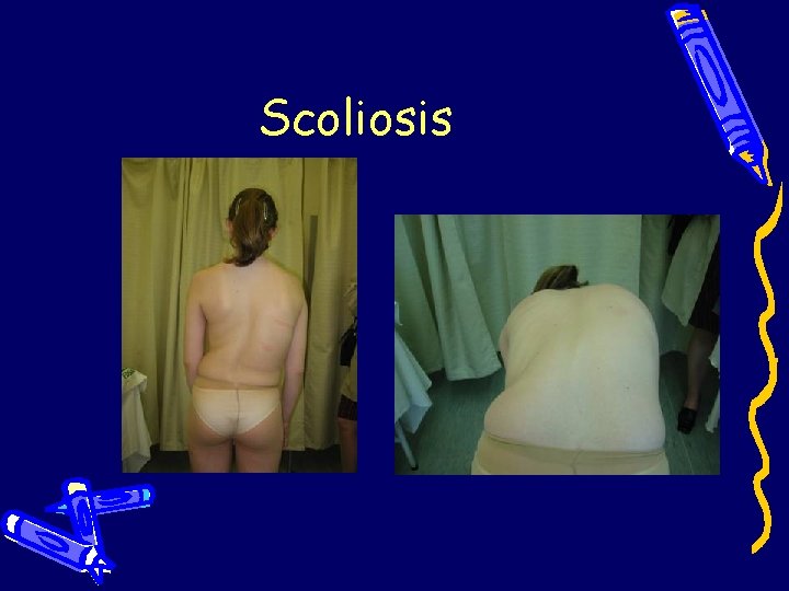 Scoliosis Scoliosis
