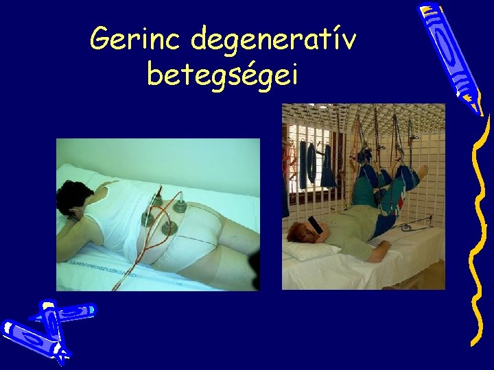 Gerinc degeneratív betegségei Gerinc degeneratív betegségei
