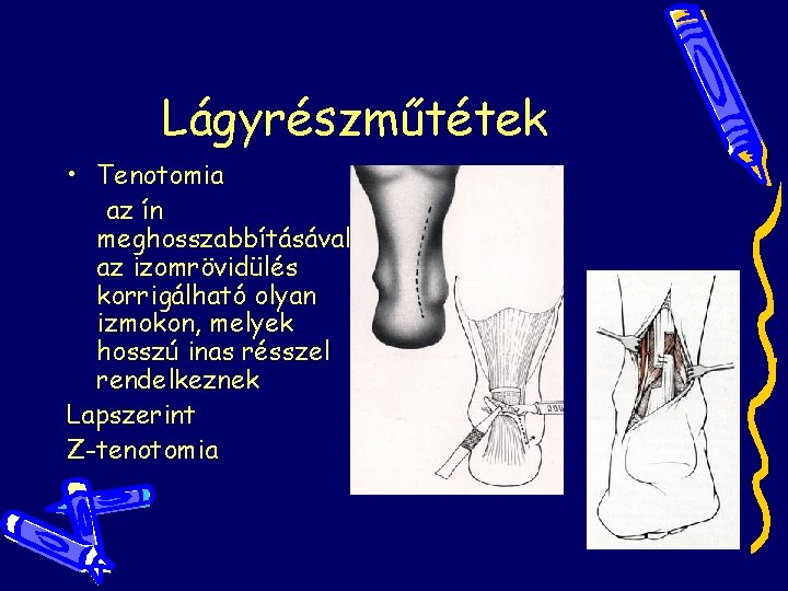 Lágyrészműtétek • Tenotomia az ín meghosszabbításával az izomrövidülés korrigálható olyan izmokon, melyek hosszú inas Lágyrészműtétek • Tenotomia az ín meghosszabbításával az izomrövidülés korrigálható olyan izmokon, melyek hosszú inas