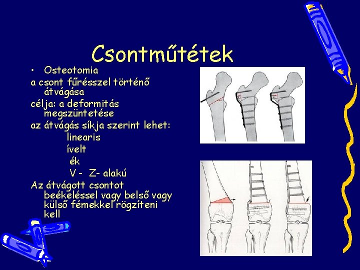 Csontműtétek • Osteotomia a csont fűrésszel történő átvágása célja: a deformitás megszüntetése az átvágás Csontműtétek • Osteotomia a csont fűrésszel történő átvágása célja: a deformitás megszüntetése az átvágás