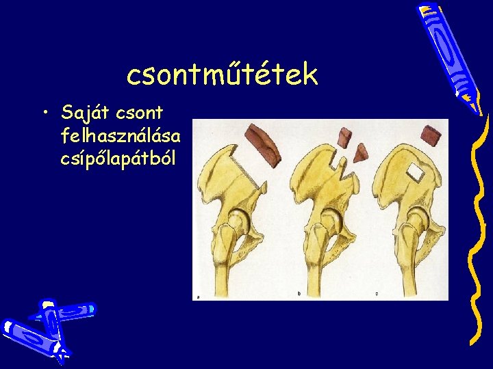 csontműtétek • Saját csont felhasználása csípőlapátból csontműtétek • Saját csont felhasználása csípőlapátból