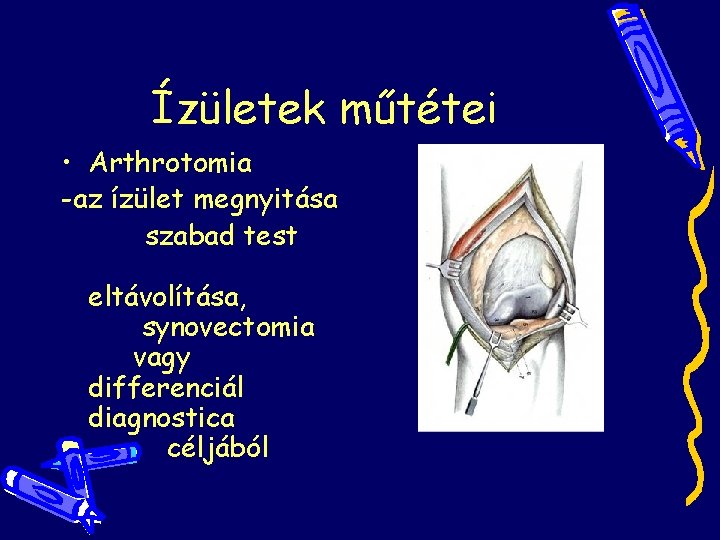 Ízületek műtétei • Arthrotomia -az ízület megnyitása szabad test eltávolítása, synovectomia vagy differenciál diagnostica Ízületek műtétei • Arthrotomia -az ízület megnyitása szabad test eltávolítása, synovectomia vagy differenciál diagnostica