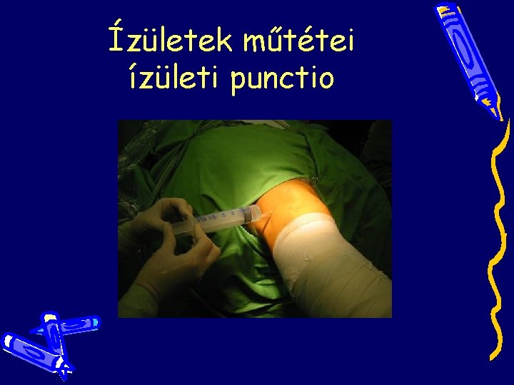 Ízületek műtétei ízületi punctio Ízületek műtétei ízületi punctio