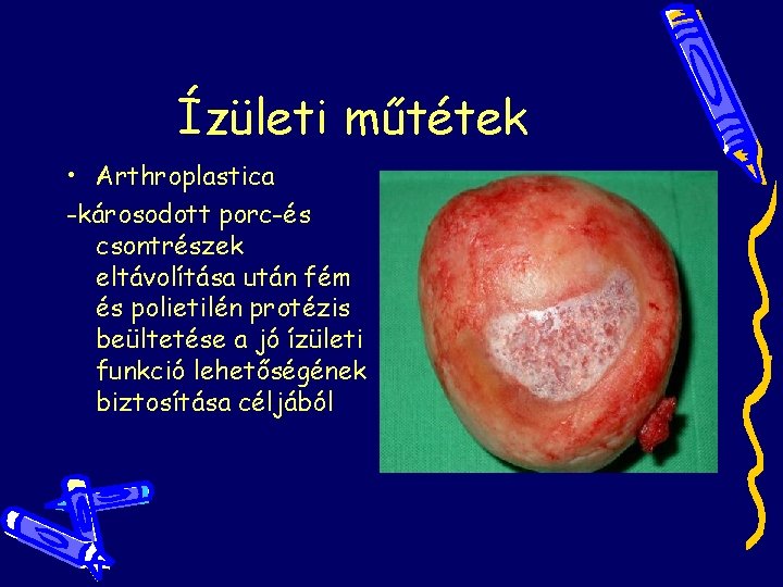 Ízületi műtétek • Arthroplastica -károsodott porc-és csontrészek eltávolítása után fém és polietilén protézis beültetése Ízületi műtétek • Arthroplastica -károsodott porc-és csontrészek eltávolítása után fém és polietilén protézis beültetése