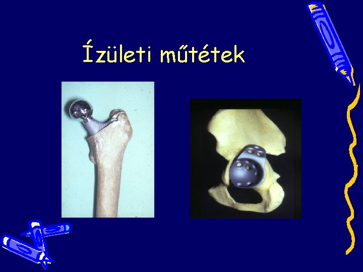 Ízületi műtétek Ízületi műtétek