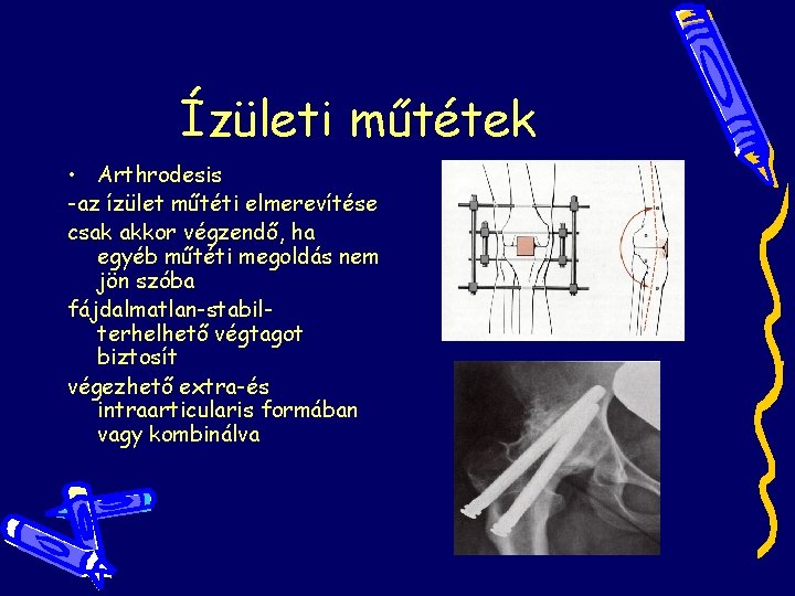 Ízületi műtétek • Arthrodesis -az ízület műtéti elmerevítése csak akkor végzendő, ha egyéb műtéti Ízületi műtétek • Arthrodesis -az ízület műtéti elmerevítése csak akkor végzendő, ha egyéb műtéti