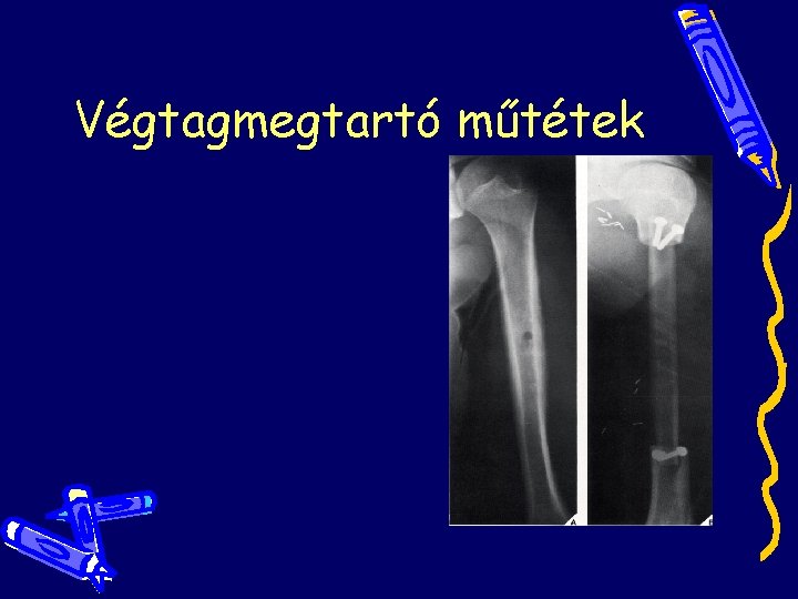 Végtagmegtartó műtétek Végtagmegtartó műtétek