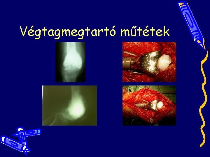 Végtagmegtartó műtétek Végtagmegtartó műtétek